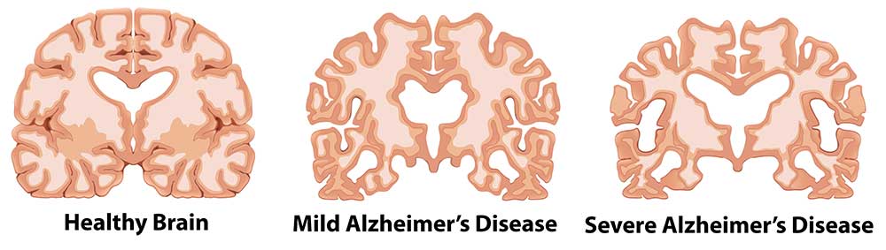 mozgani_alzheimerjeva_bolezen